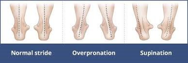 Diagram showing four types of spinal alignment: normal stride, overpronation, supination.